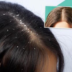 Dandruff psoriasis scalp flakes thehealthy tell yellowish