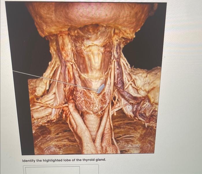 Identify the highlighted region of the thyroid gland